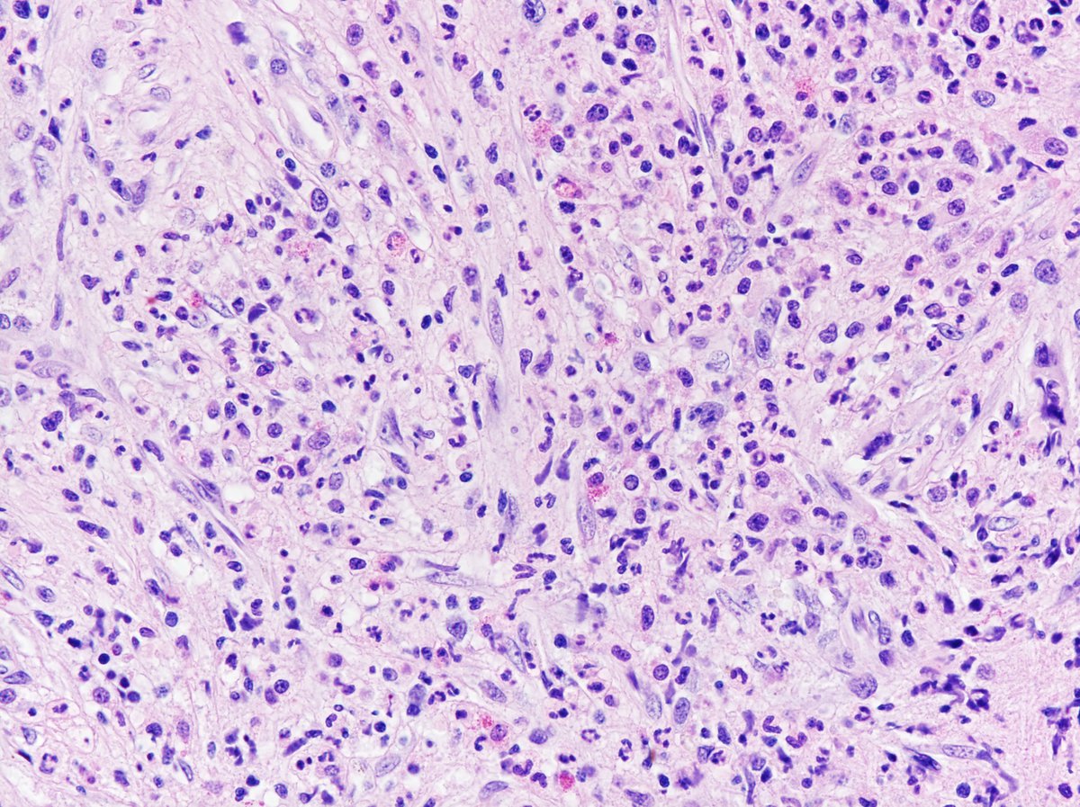 Most of the cellularity consists of mature granulocytes